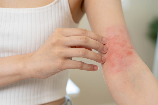 woman with itchy rash on elbow